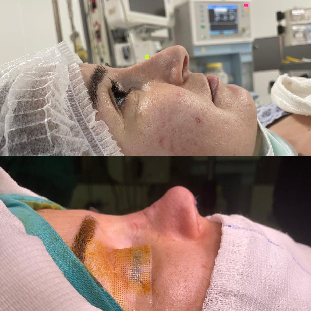 rhinoplasty