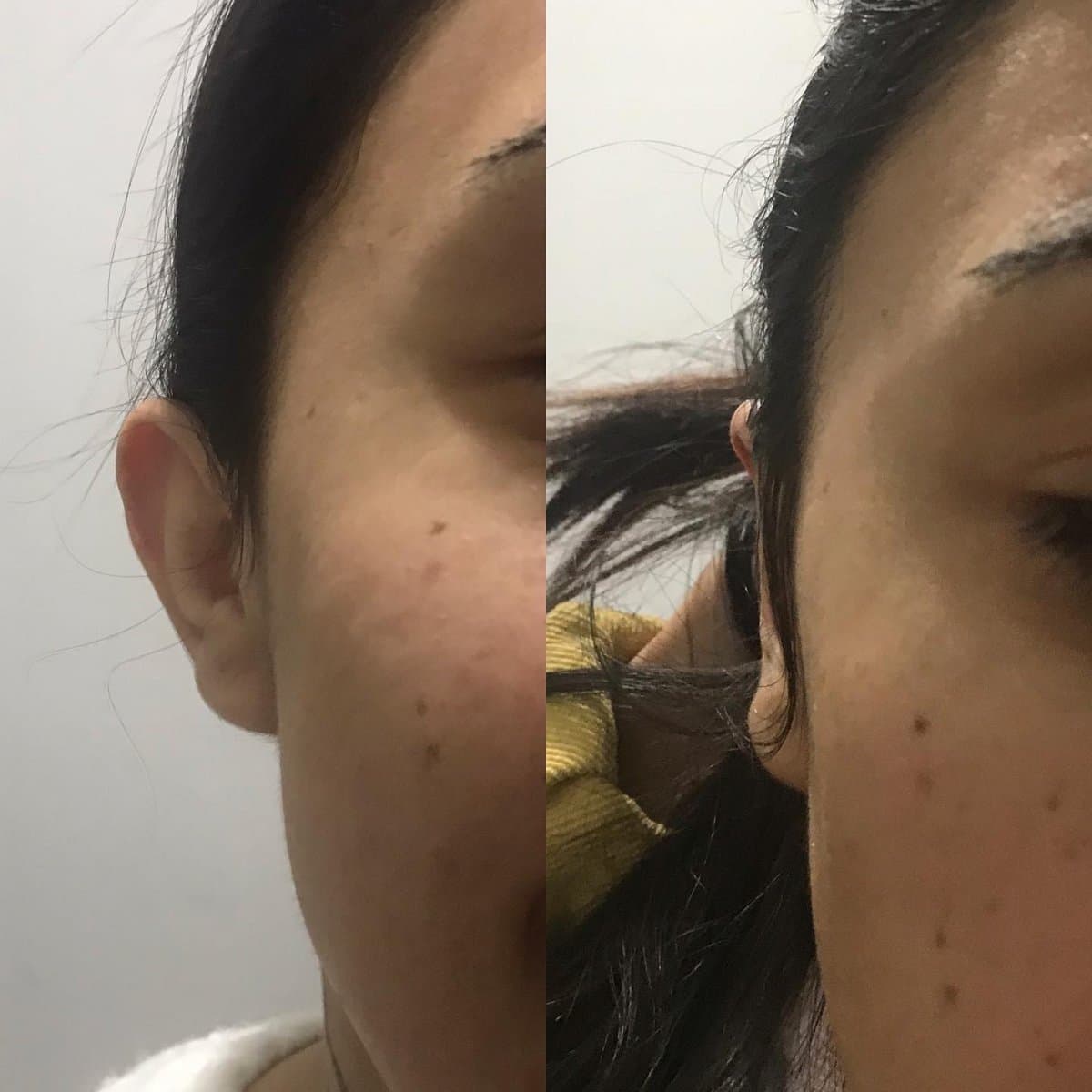 otoplasty