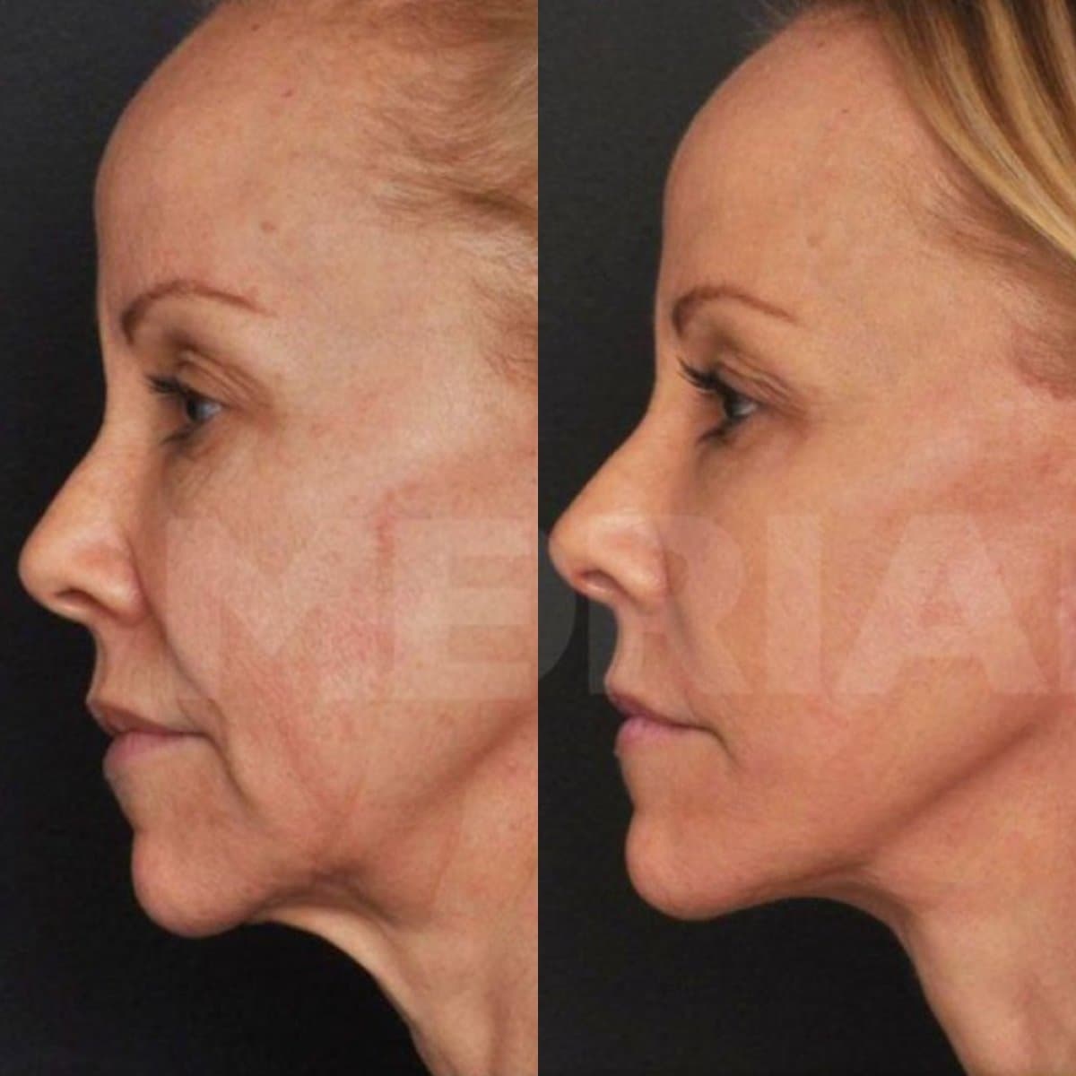 deep plane facelift