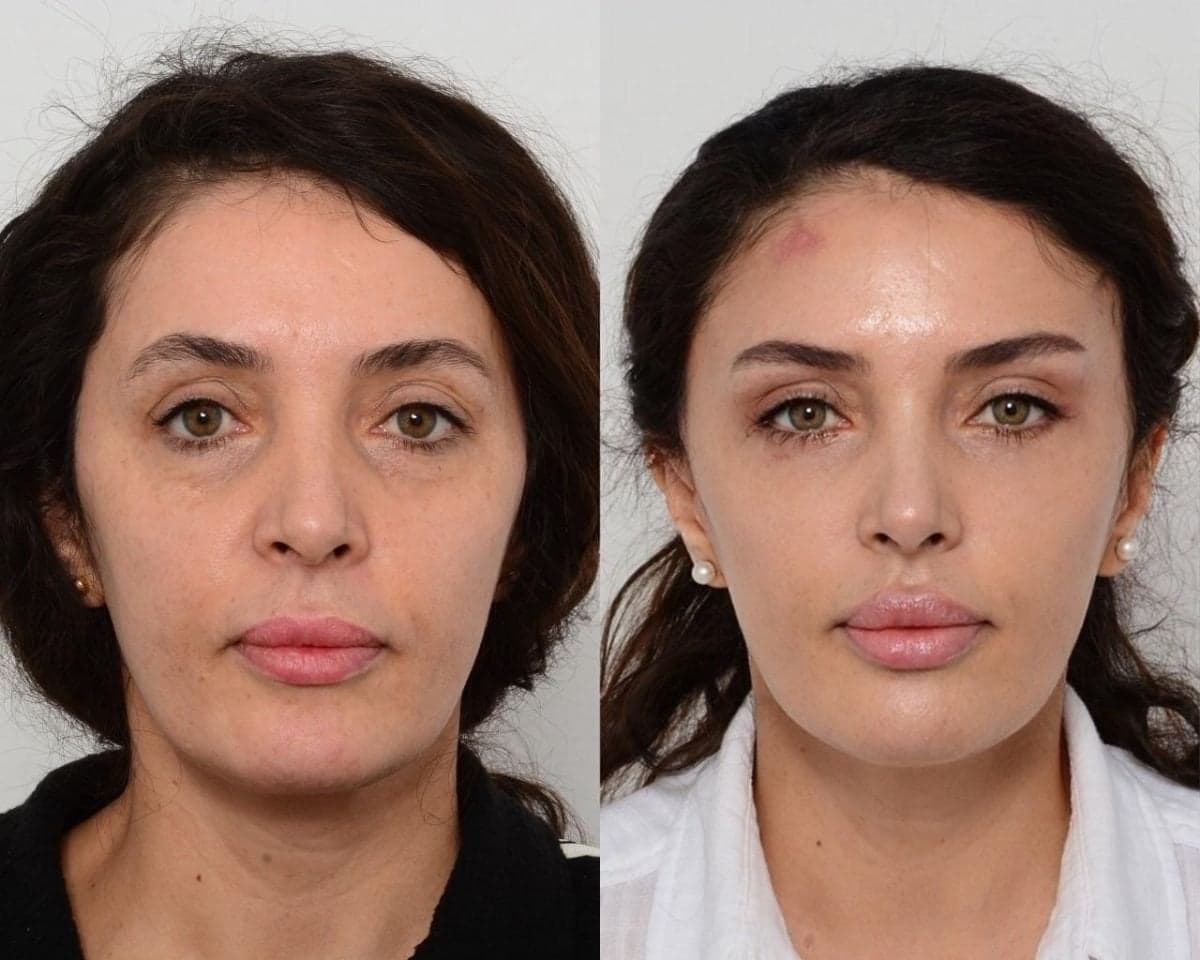 deep plane facelift