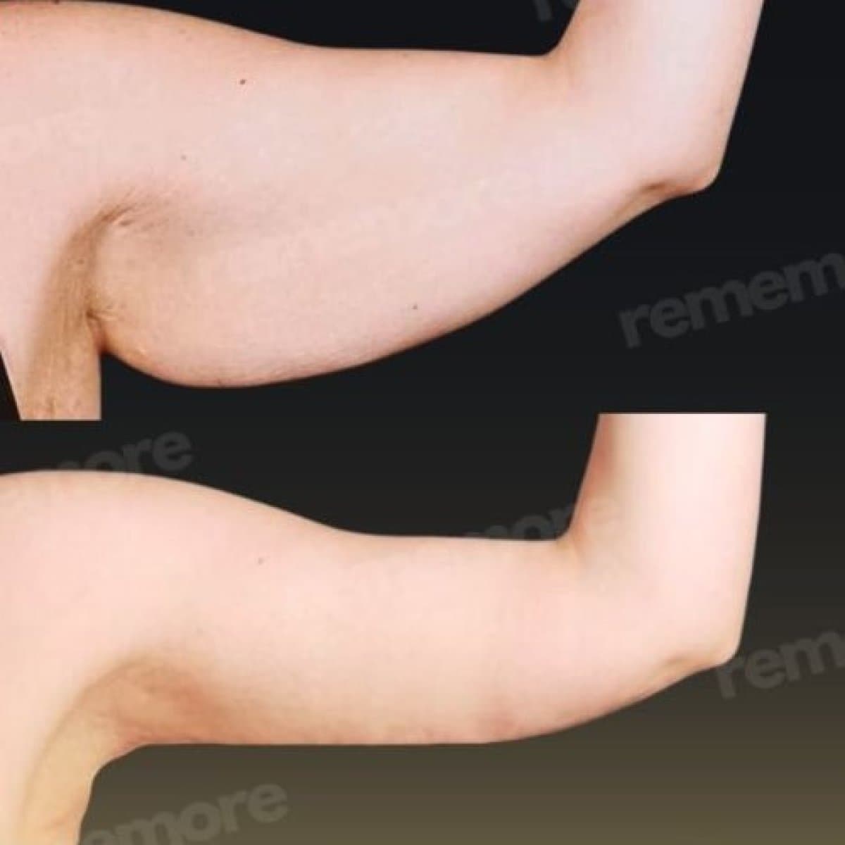 arm lift (brachioplasty)