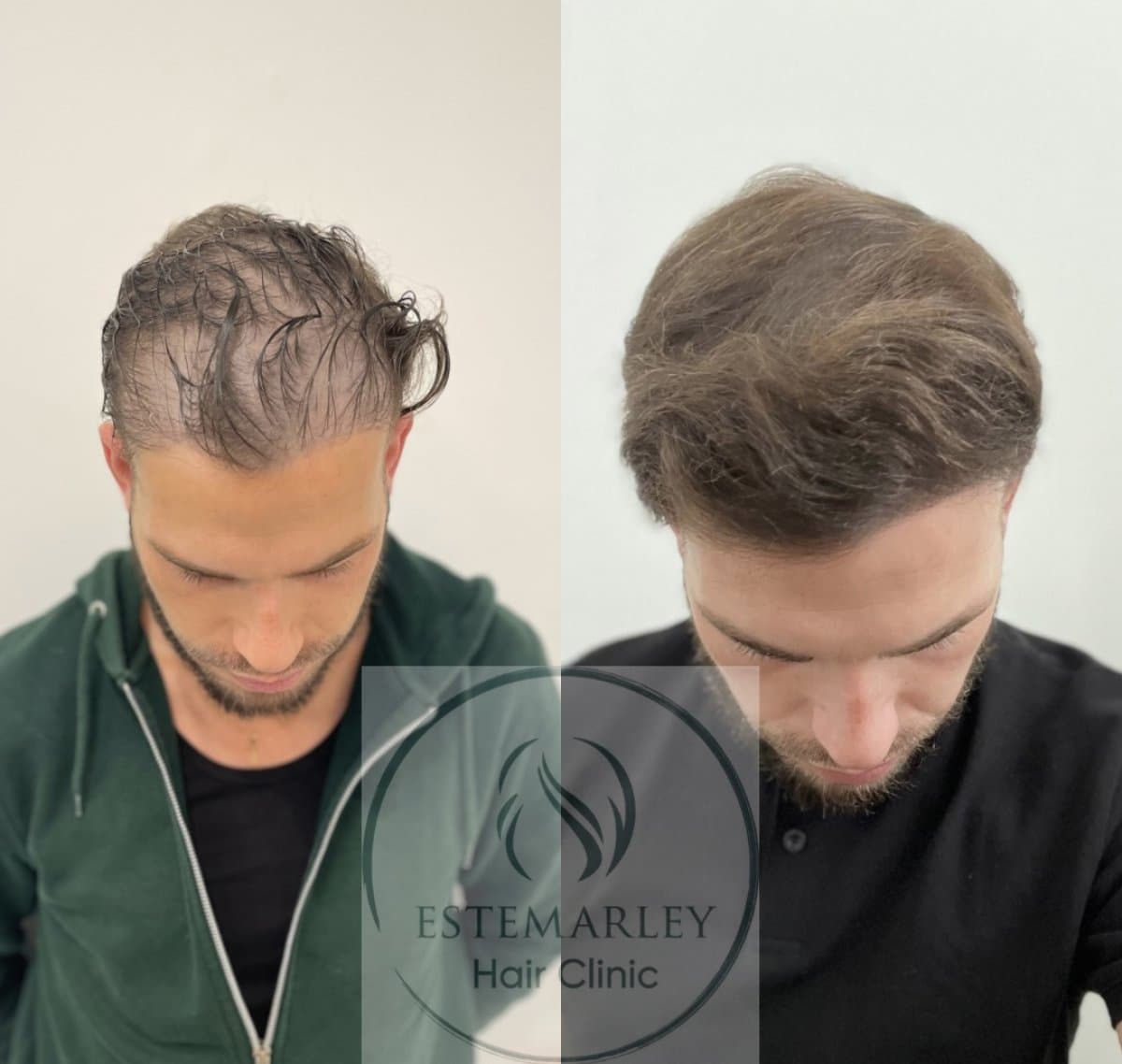 DHI hair transplant