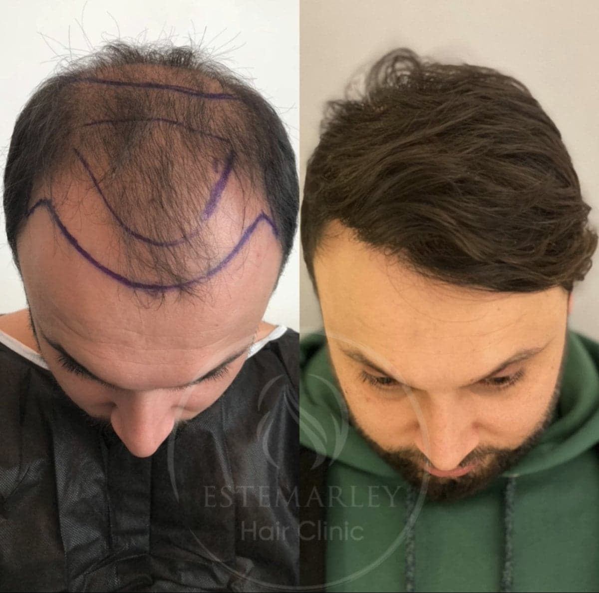 hair transplant