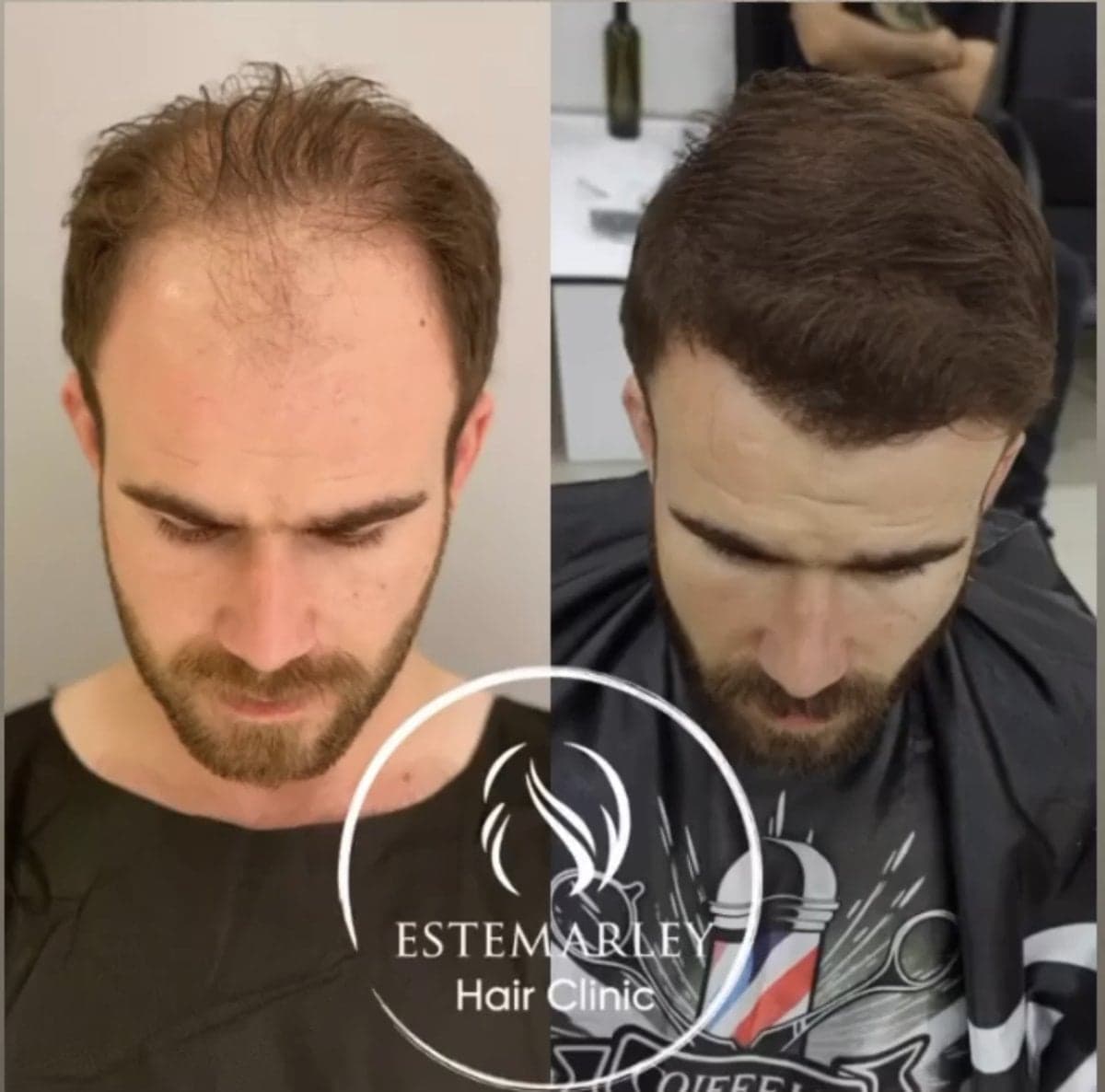 hair transplant