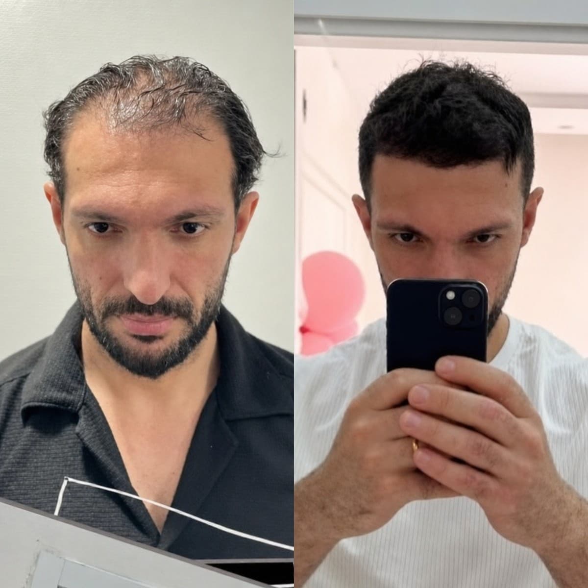 hair transplant