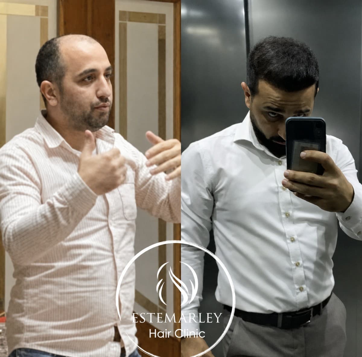 hair transplant