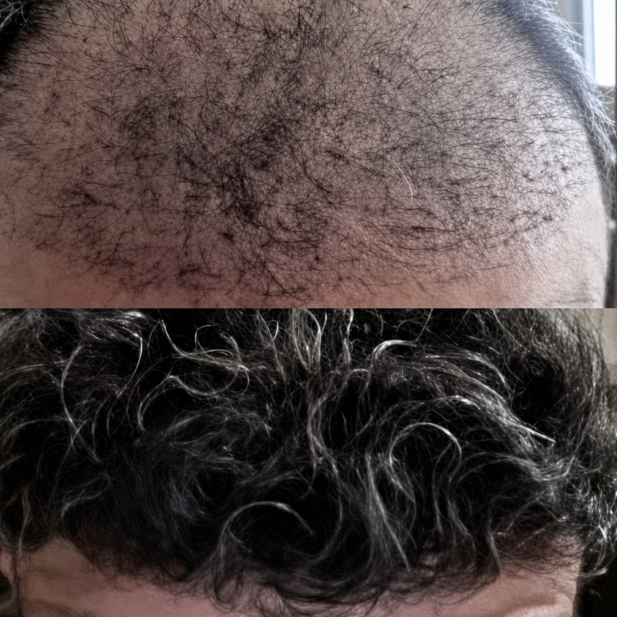 DHI hair transplant
