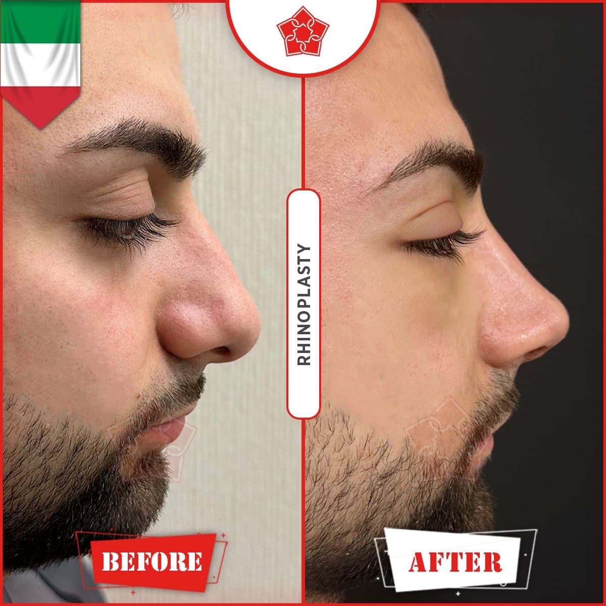 rhinoplasty