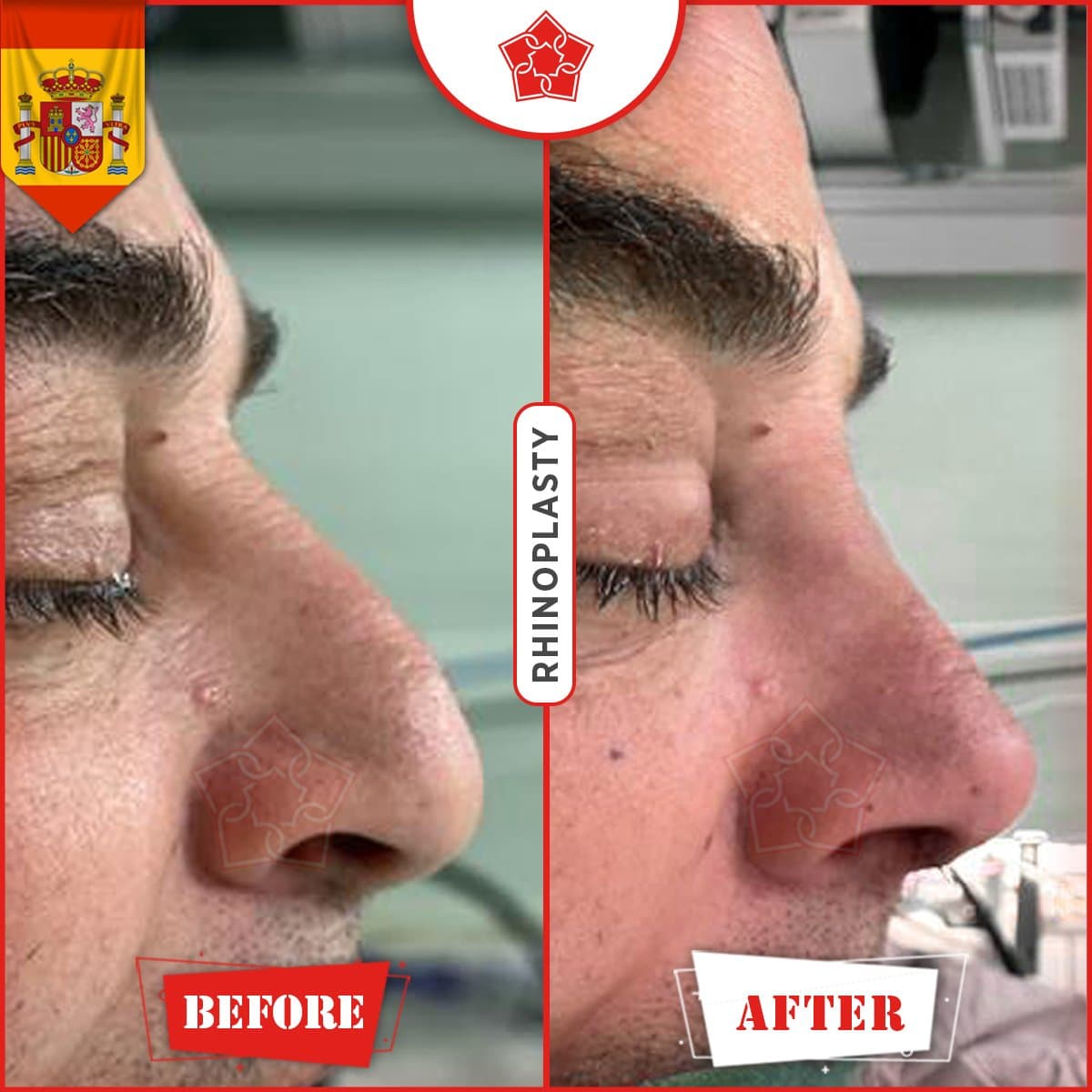 rhinoplasty