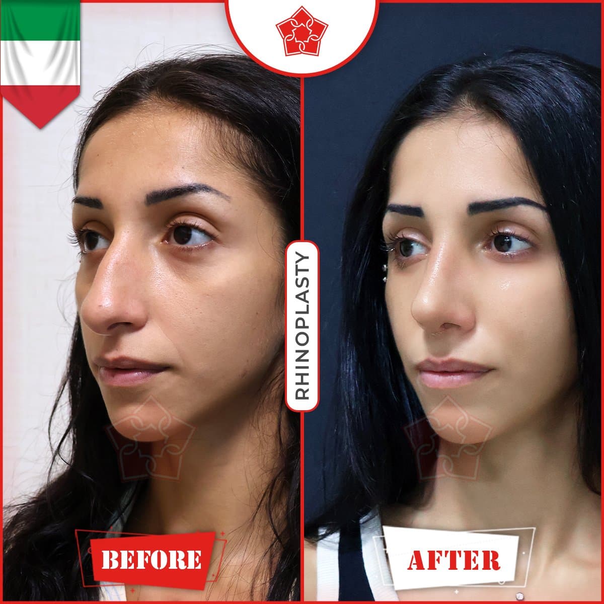 rhinoplasty