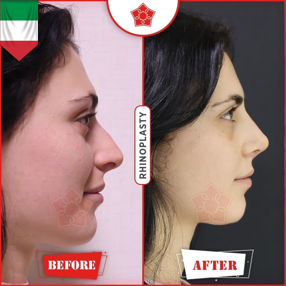 rhinoplasty