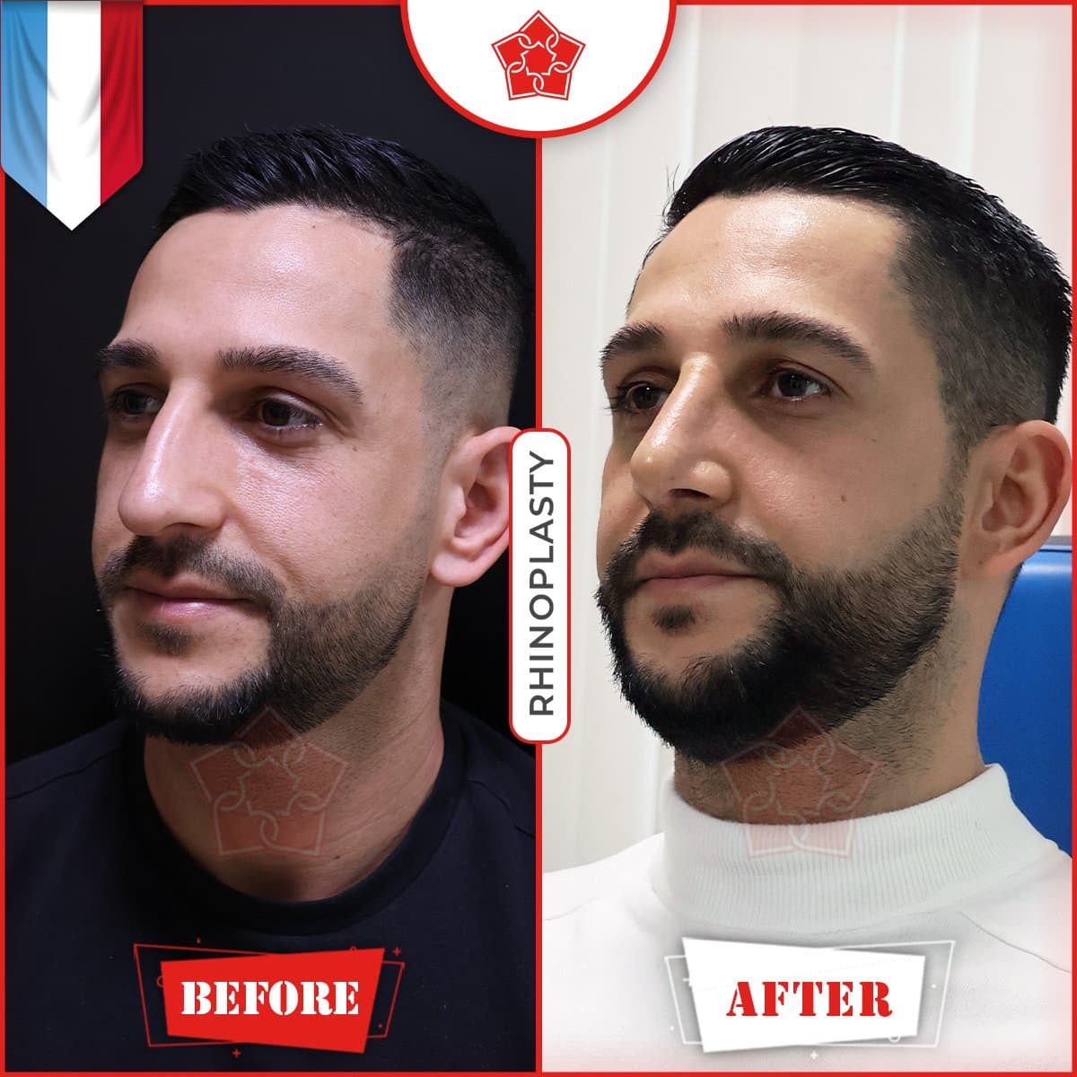 rhinoplasty