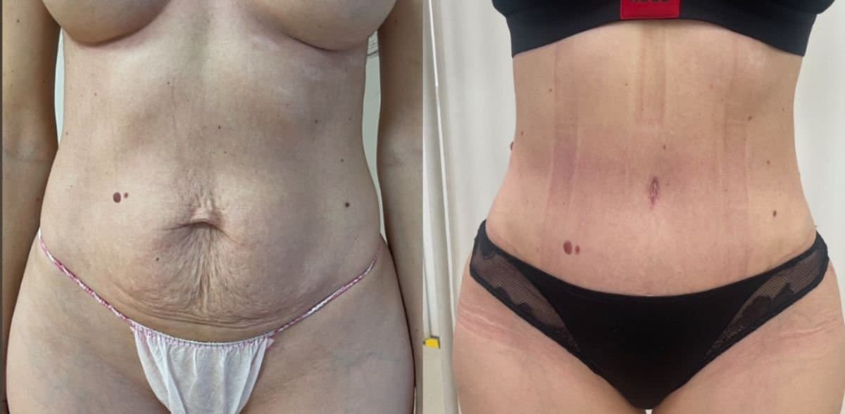 tummy tuck