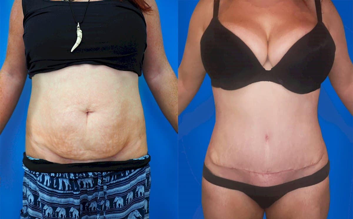 tummy tuck