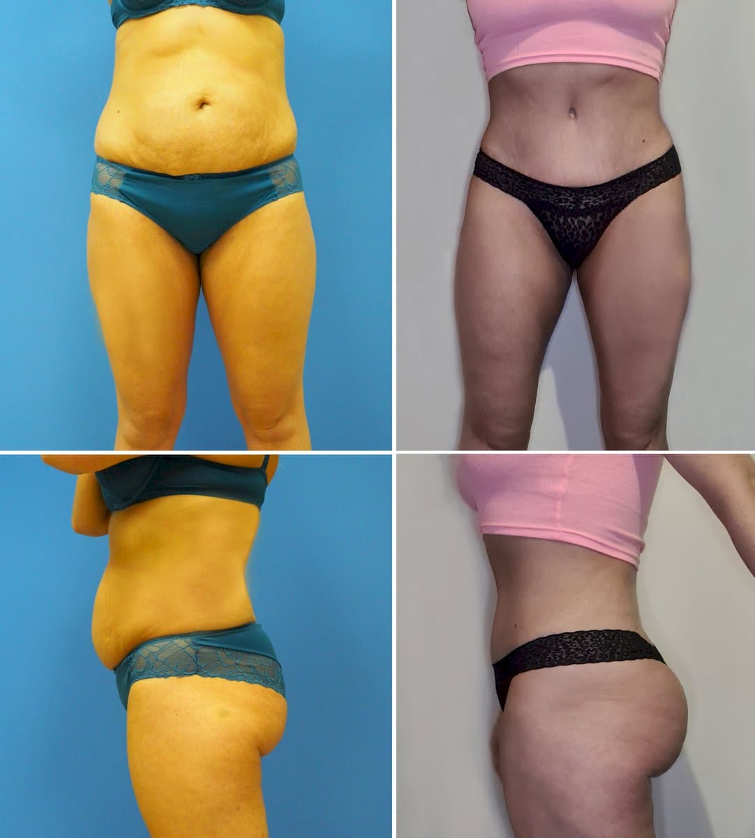 tummy tuck