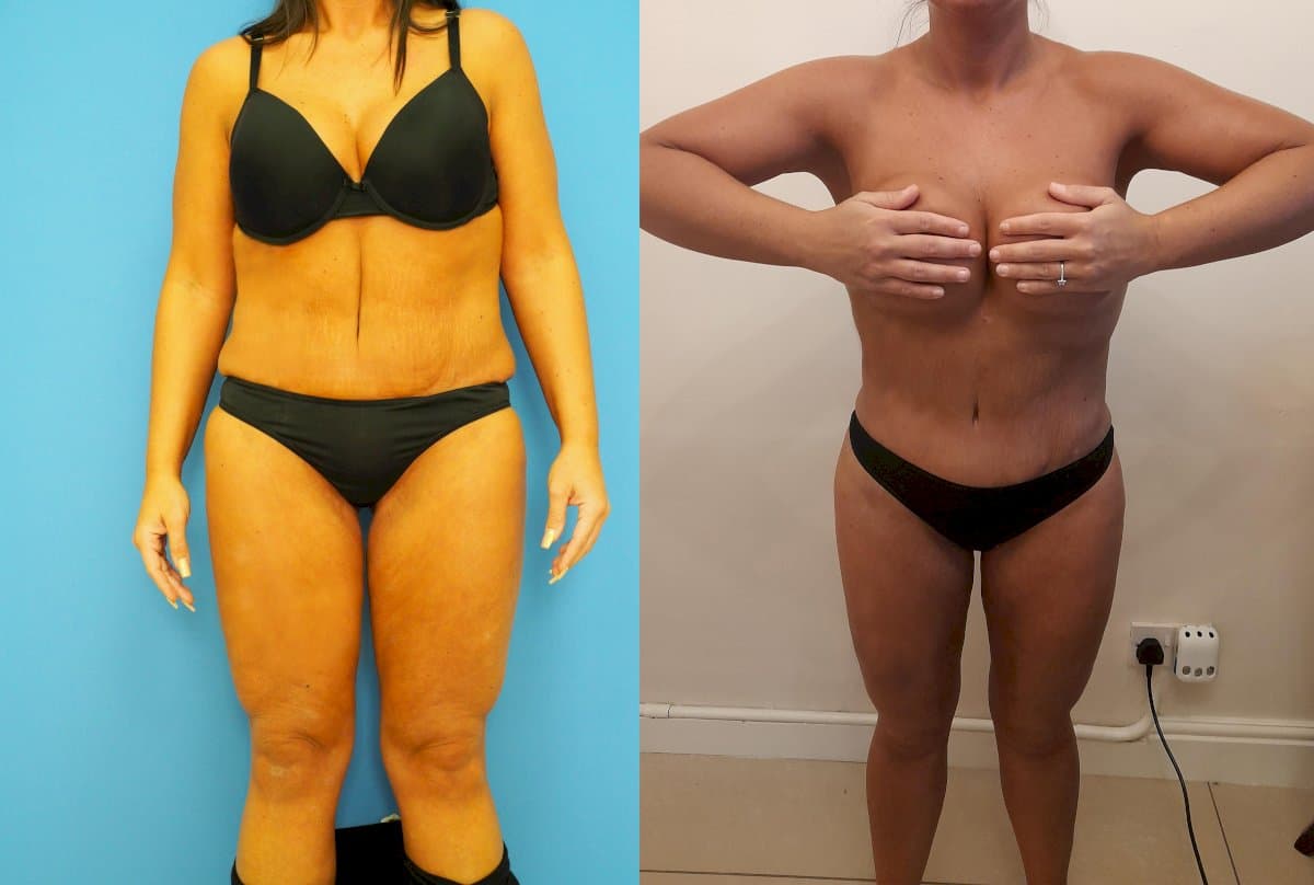 liposuction