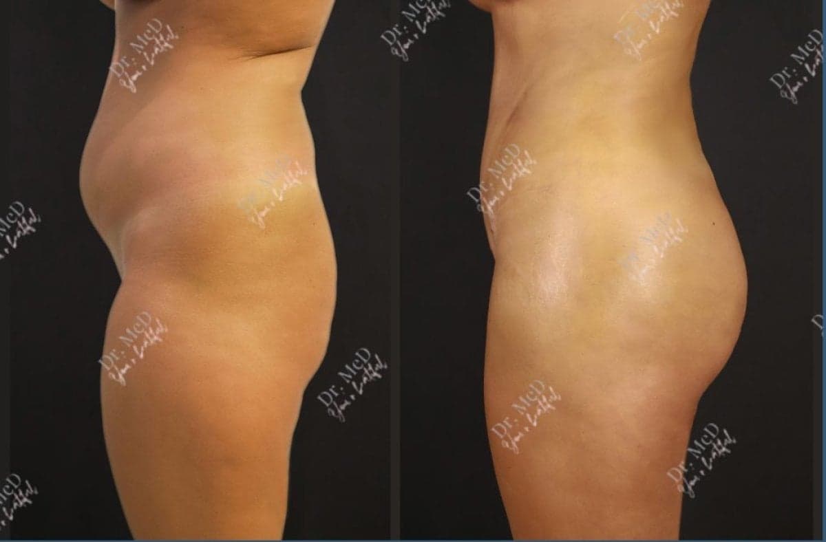 liposuction