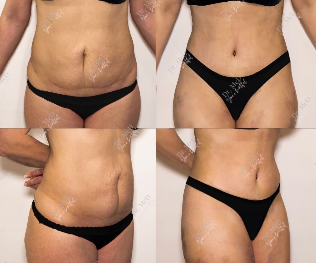 liposuction