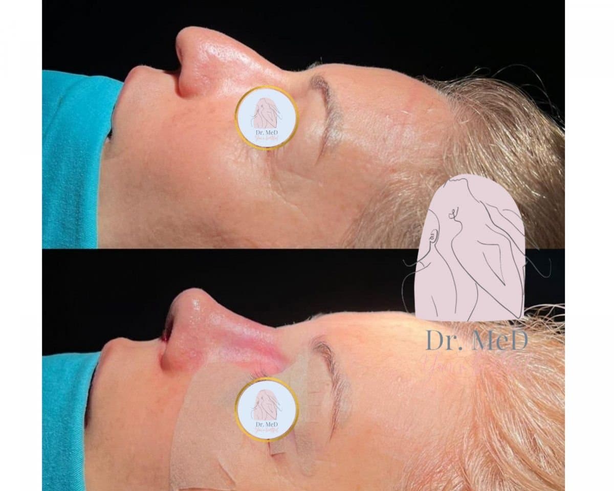 septoplasty