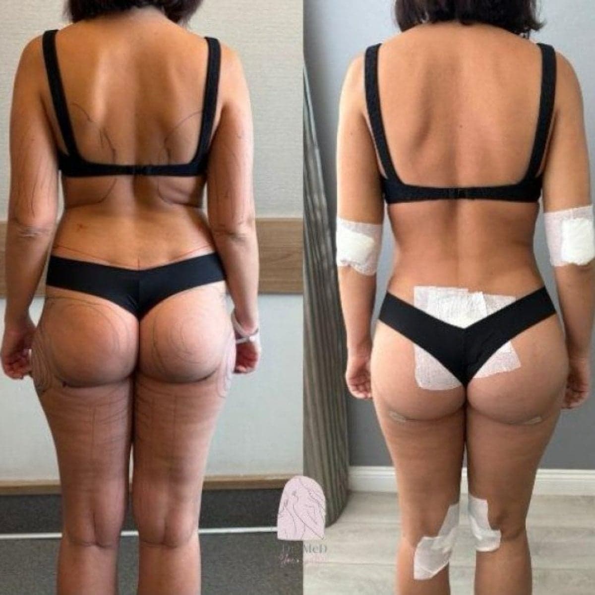 liposuction