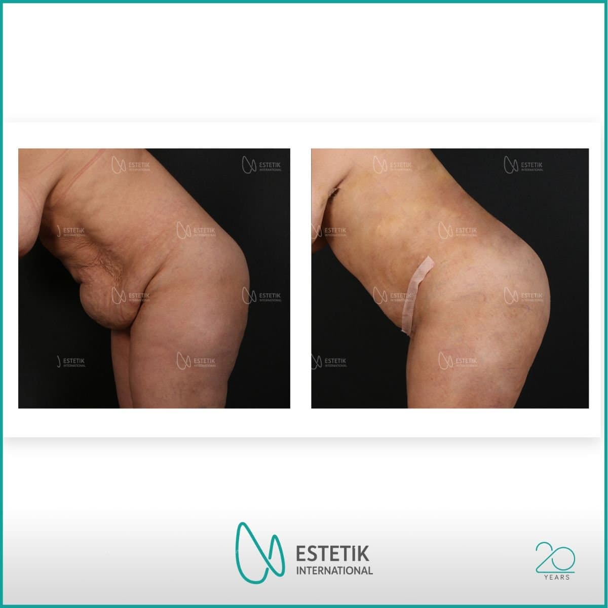 tummy tuck and liposuction