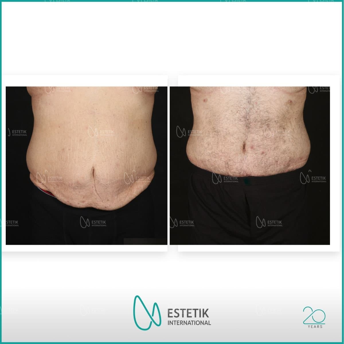 tummy tuck and liposuction