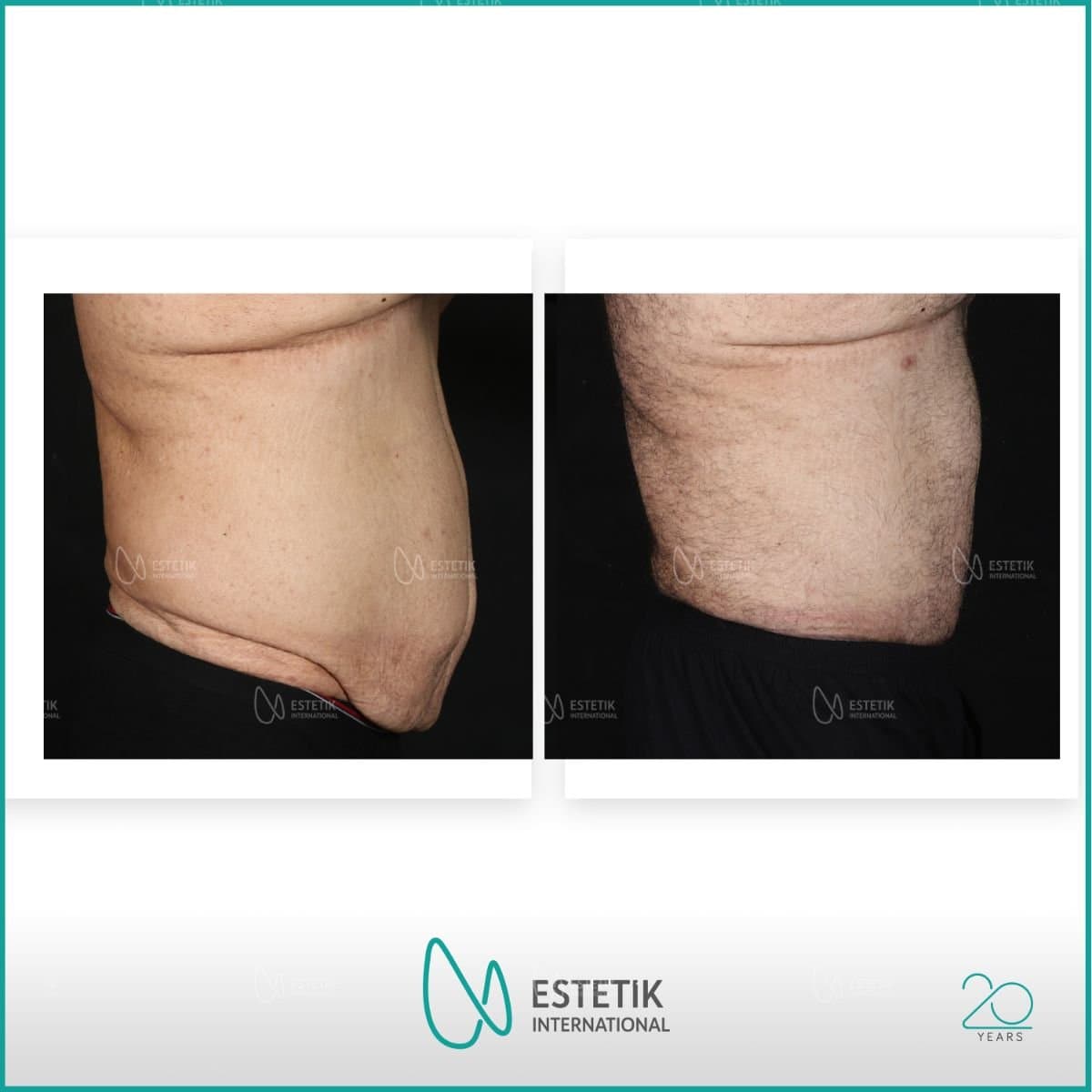 tummy tuck and liposuction