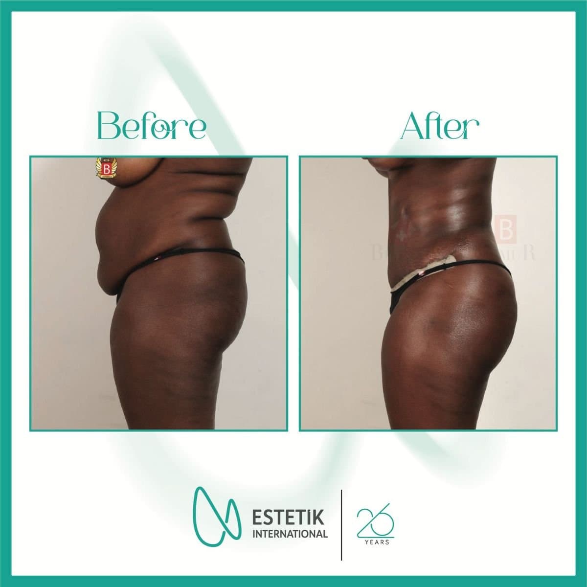 tummy tuck and liposuction