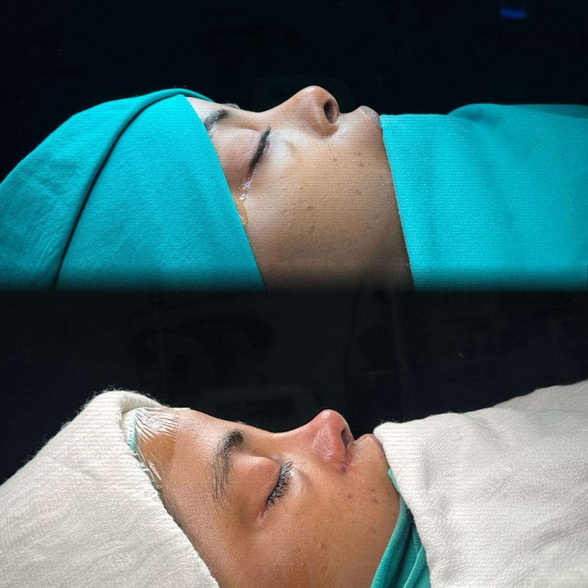 rhinoplasty