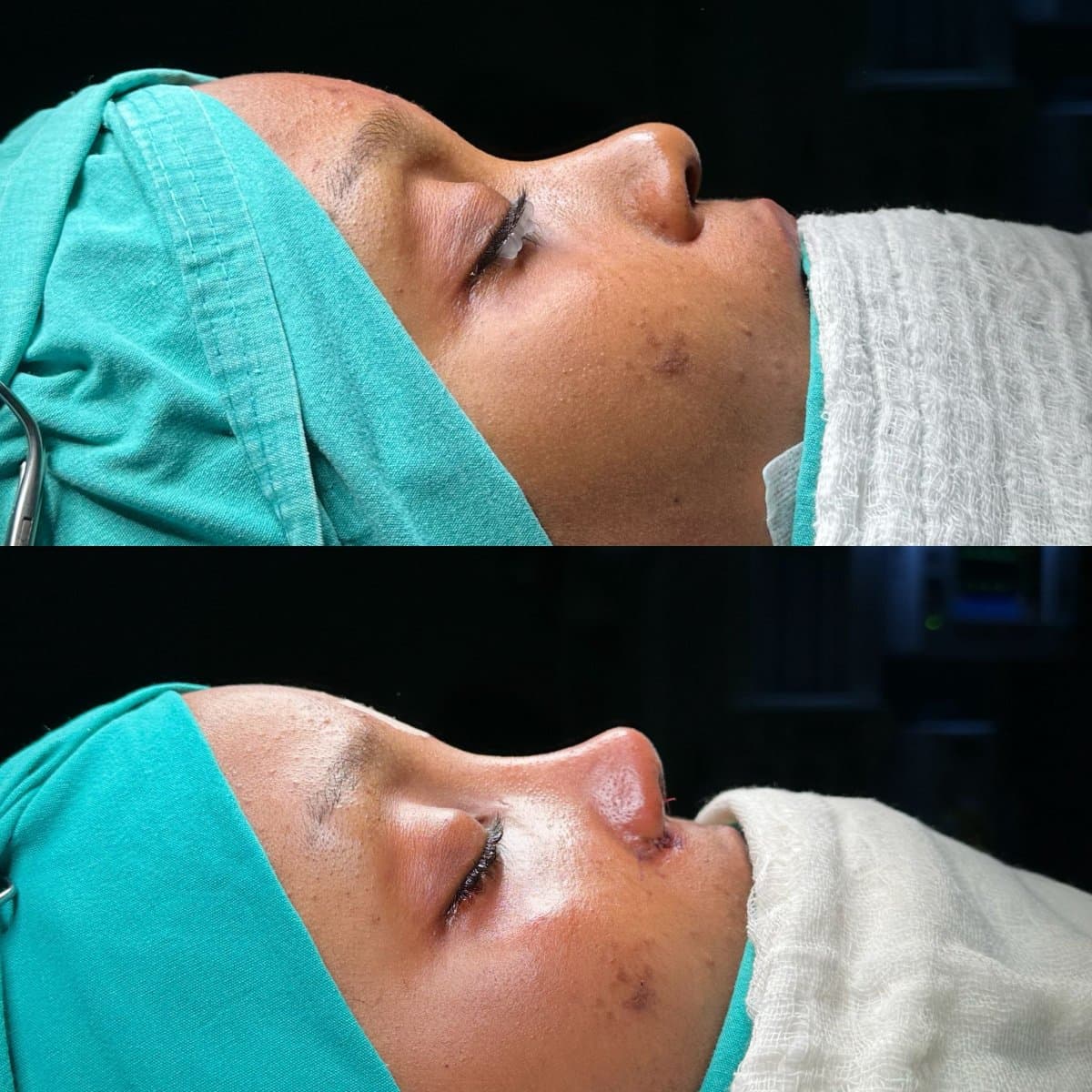rhinoplasty