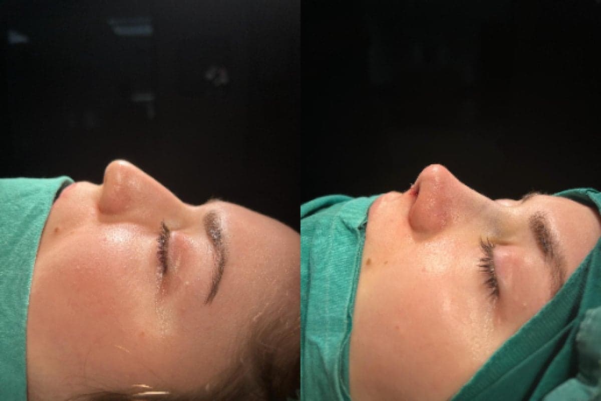 rhinoplasty