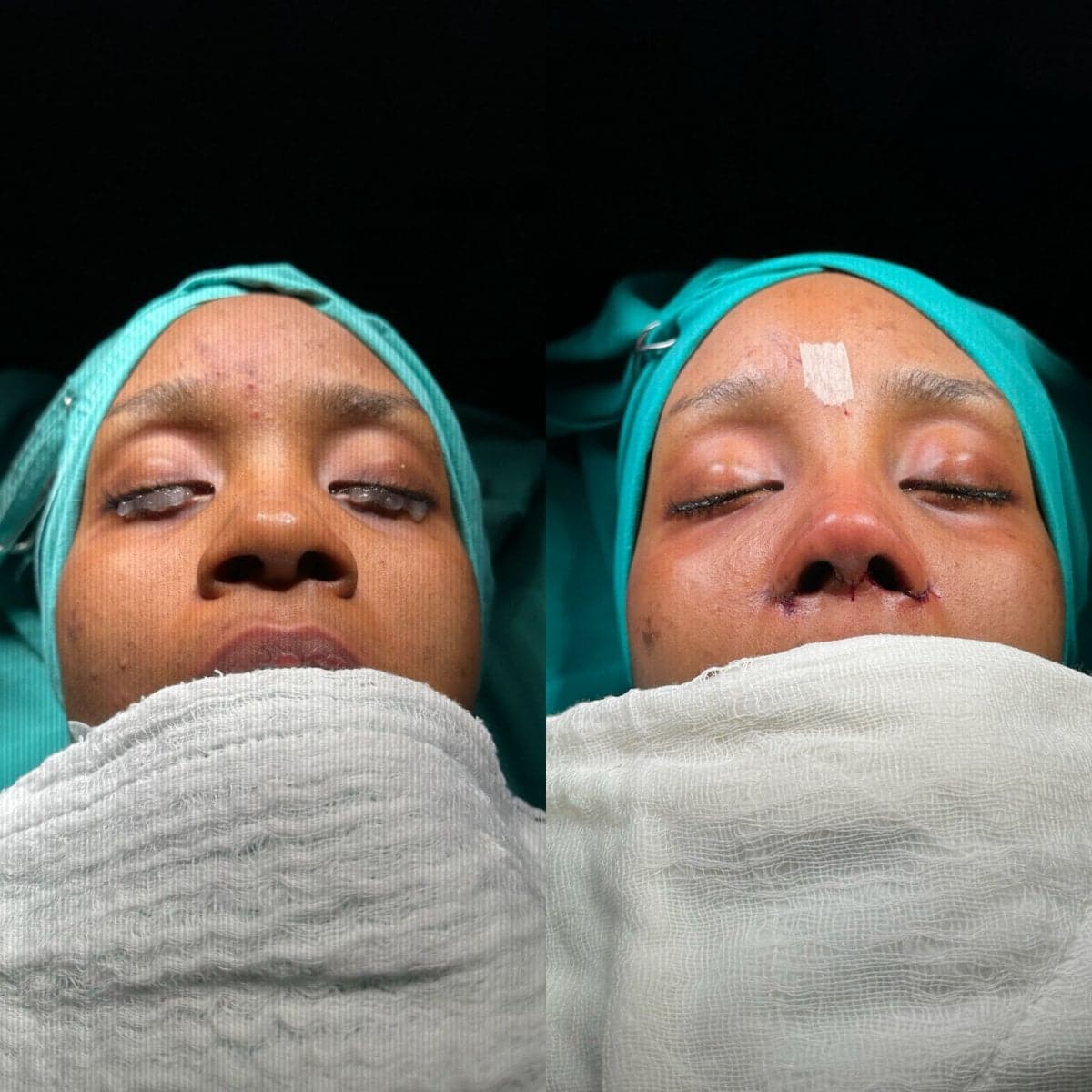 rhinoplasty