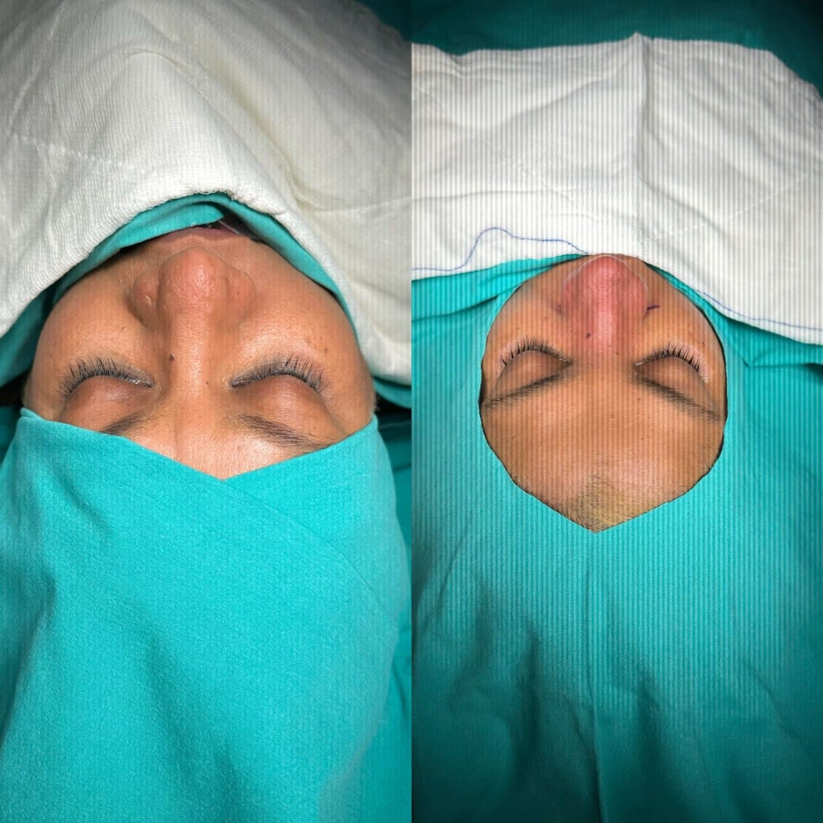 rhinoplasty