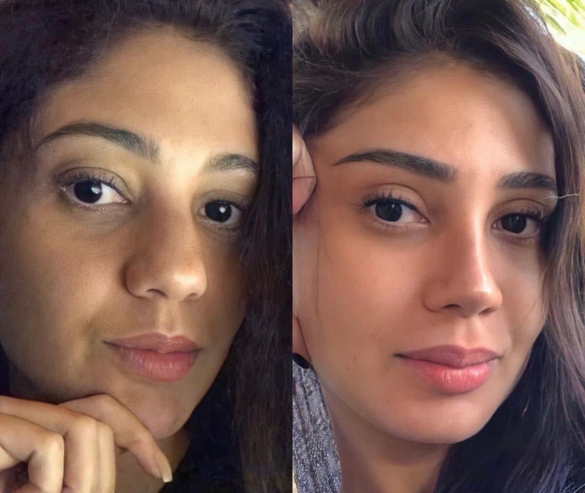 rhinoplasty