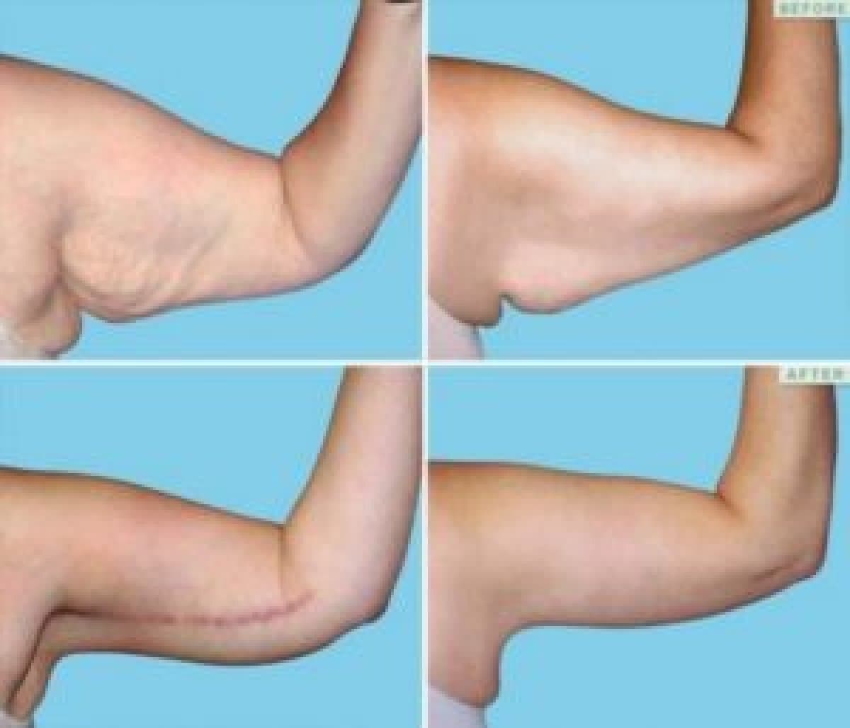 upper arm liposuction