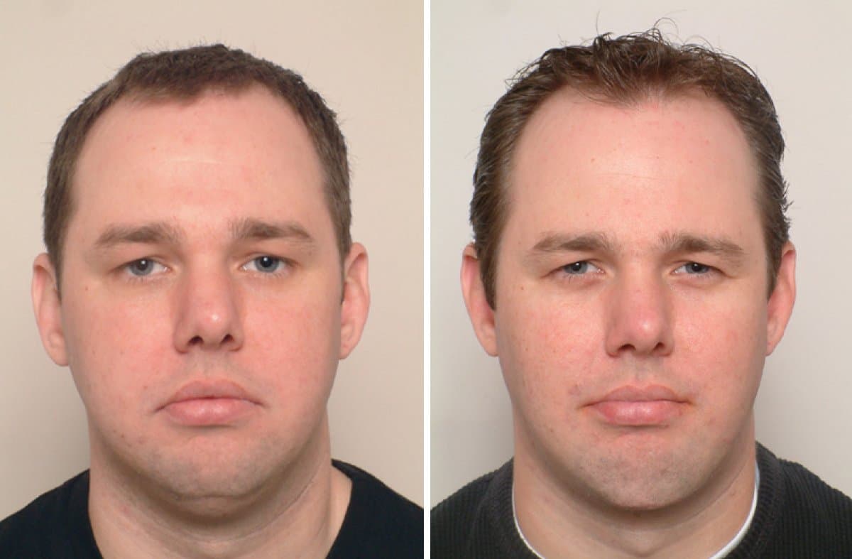 neck liposuction