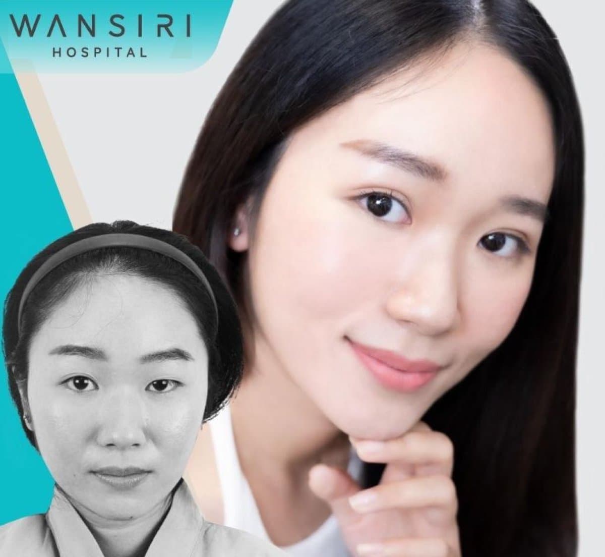 upper eyelid surgery
