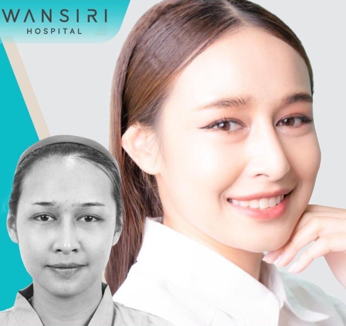 upper eyelid surgery