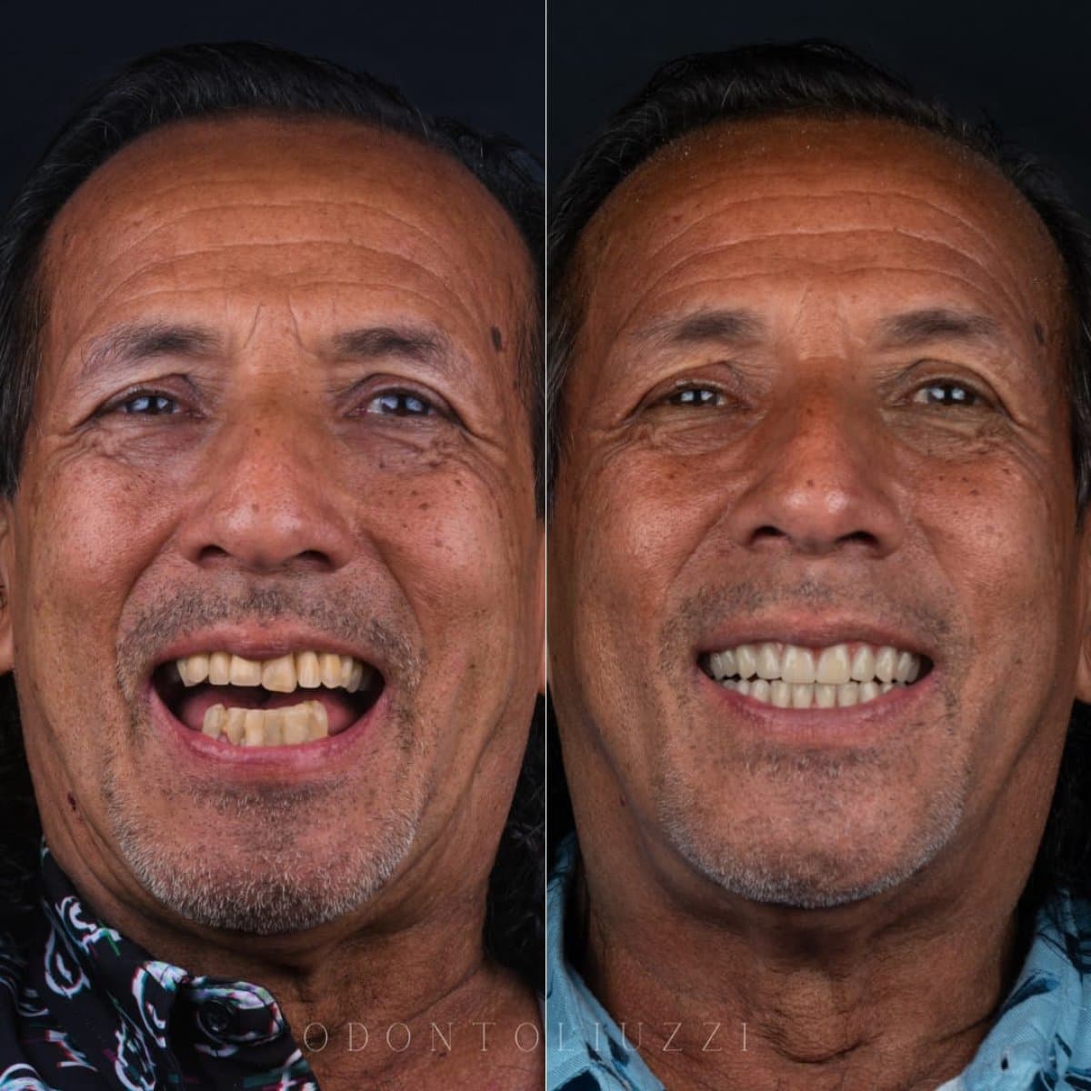 All-on-6 dental implants