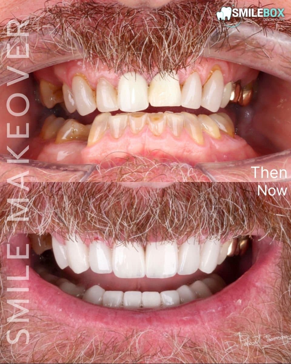 results with dental veneers