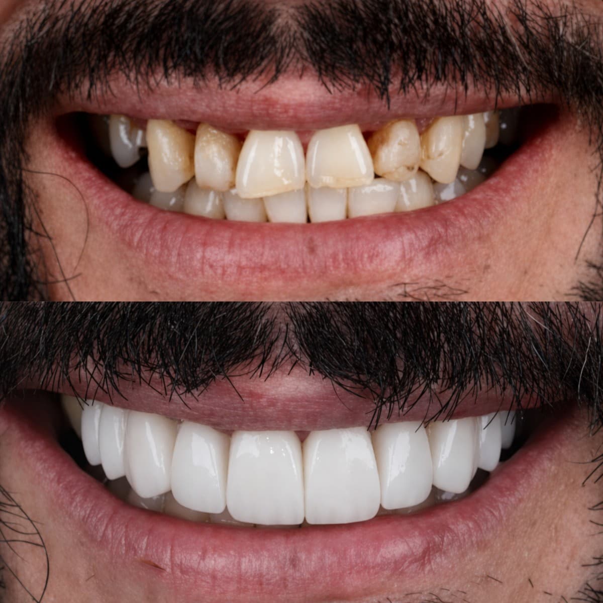 Hollywood Smile veneers
