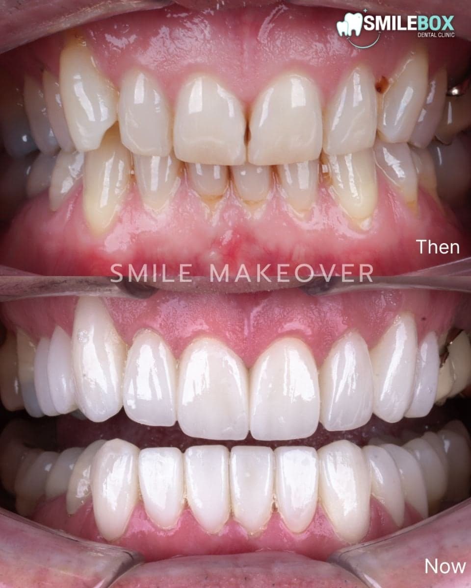 Hollywood Smile