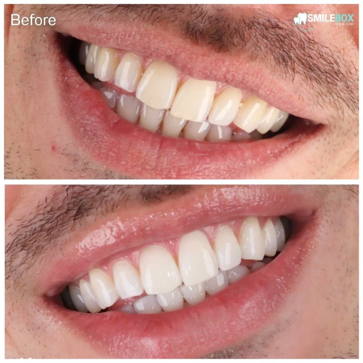 tooth whitening