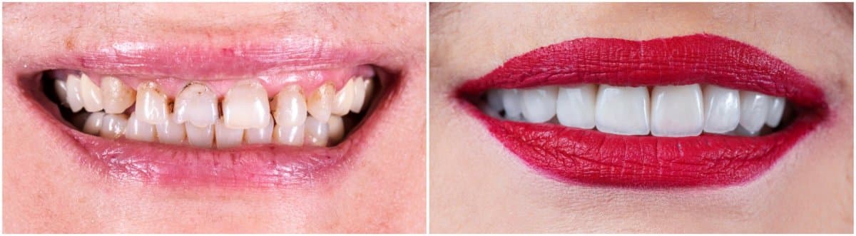 dental crown installation