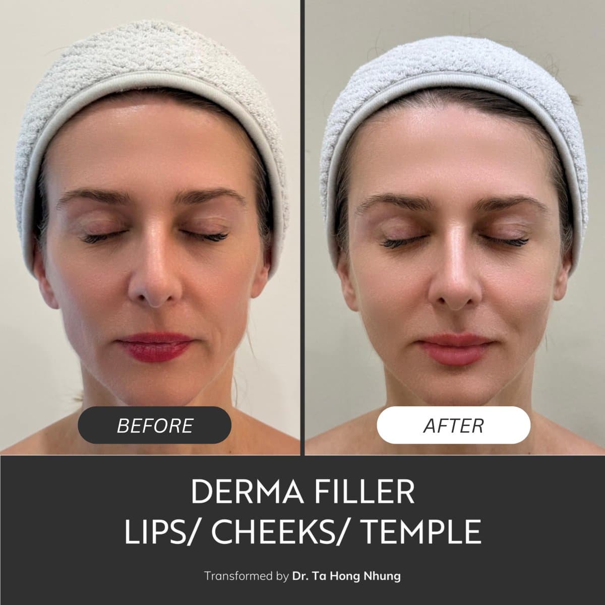 derma filler