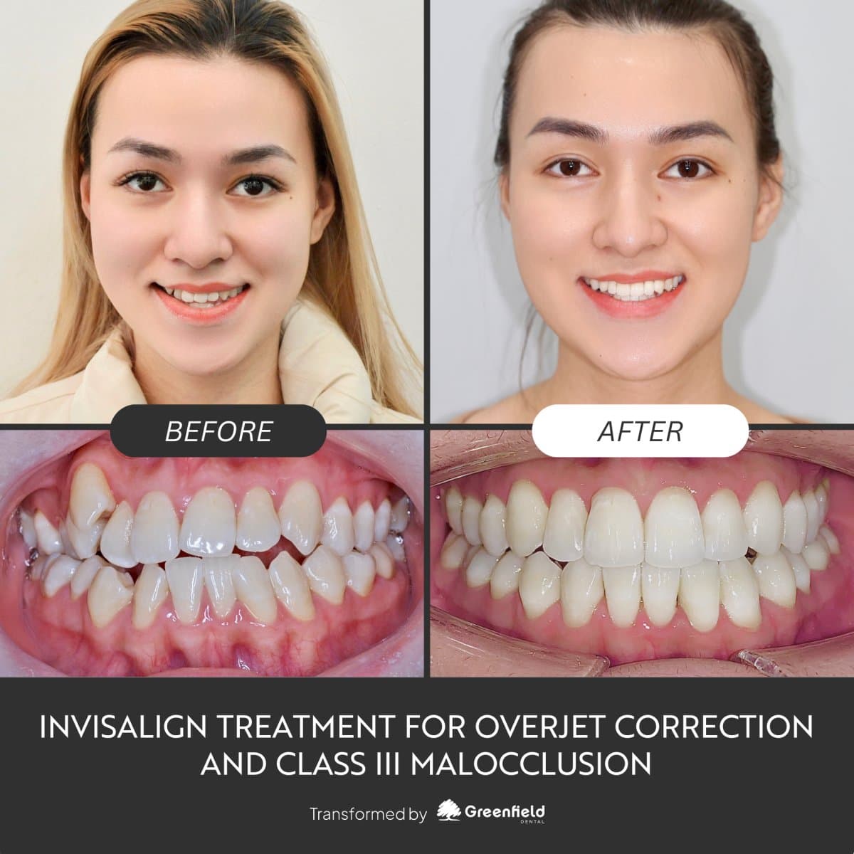 results for overjet and class III malocclusion