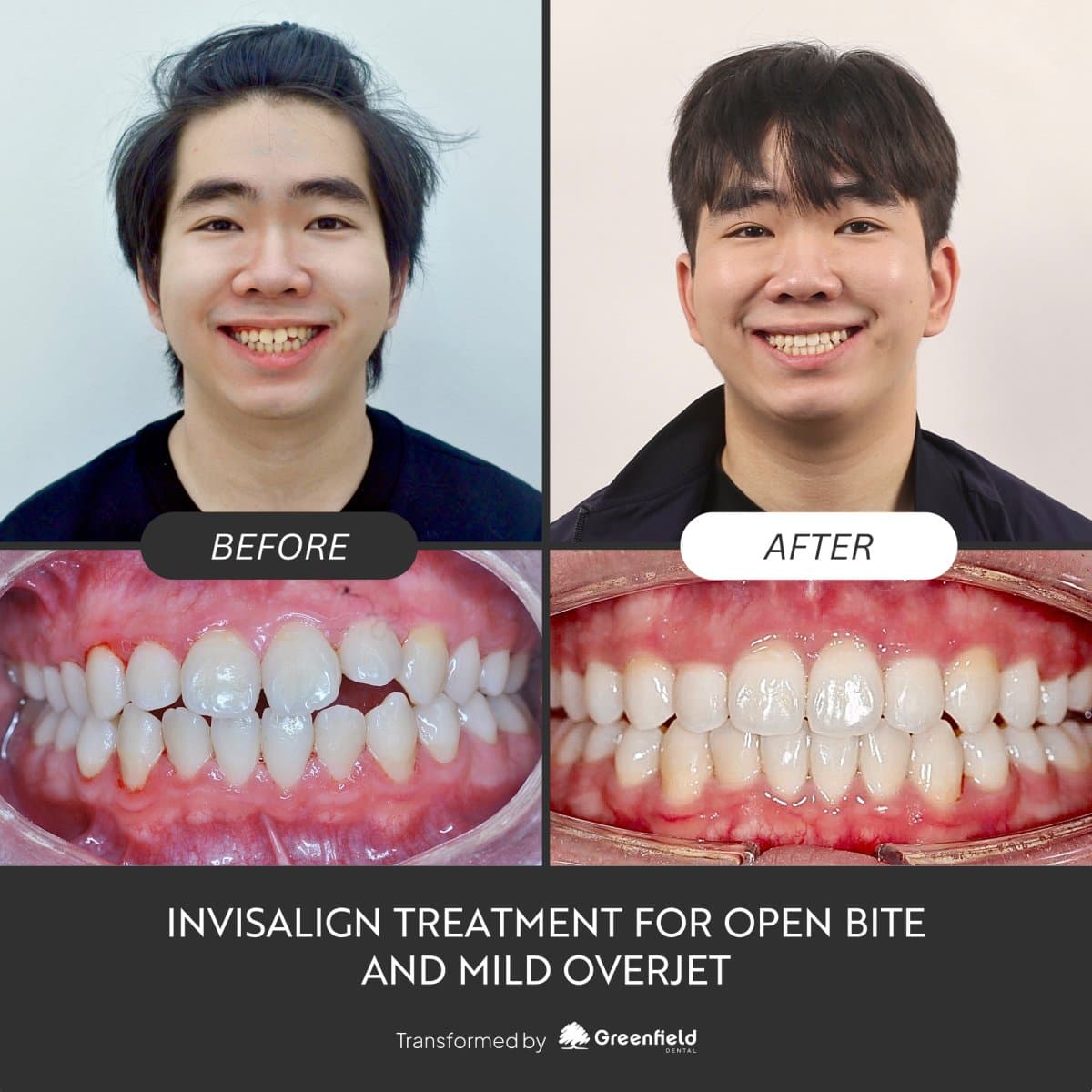 Invisalign