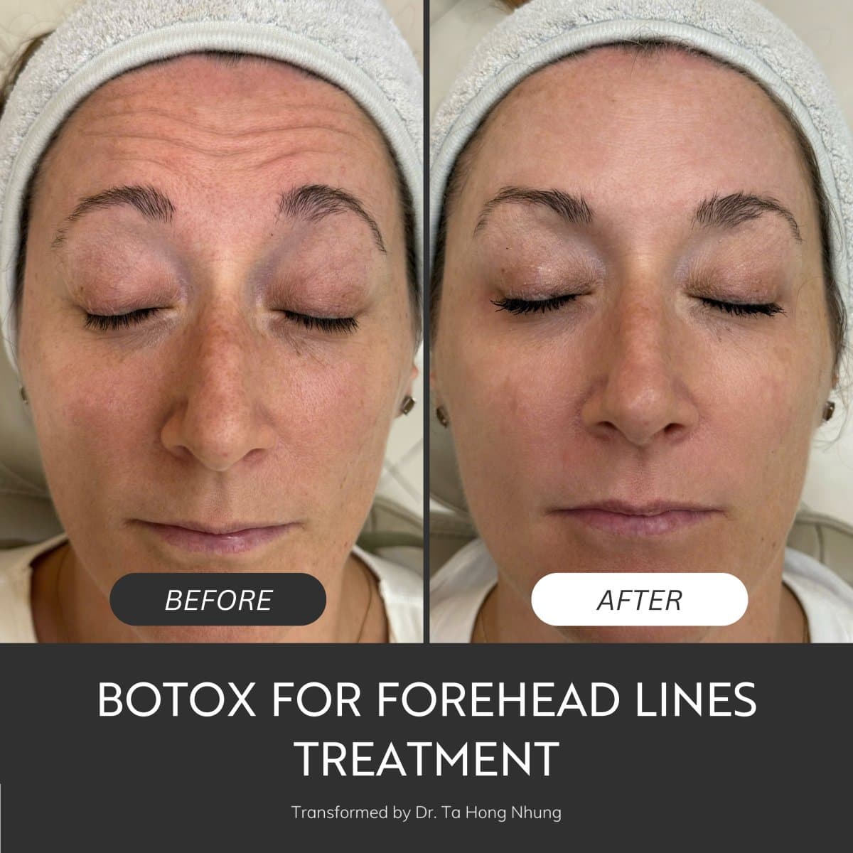 Botox for forehead lines