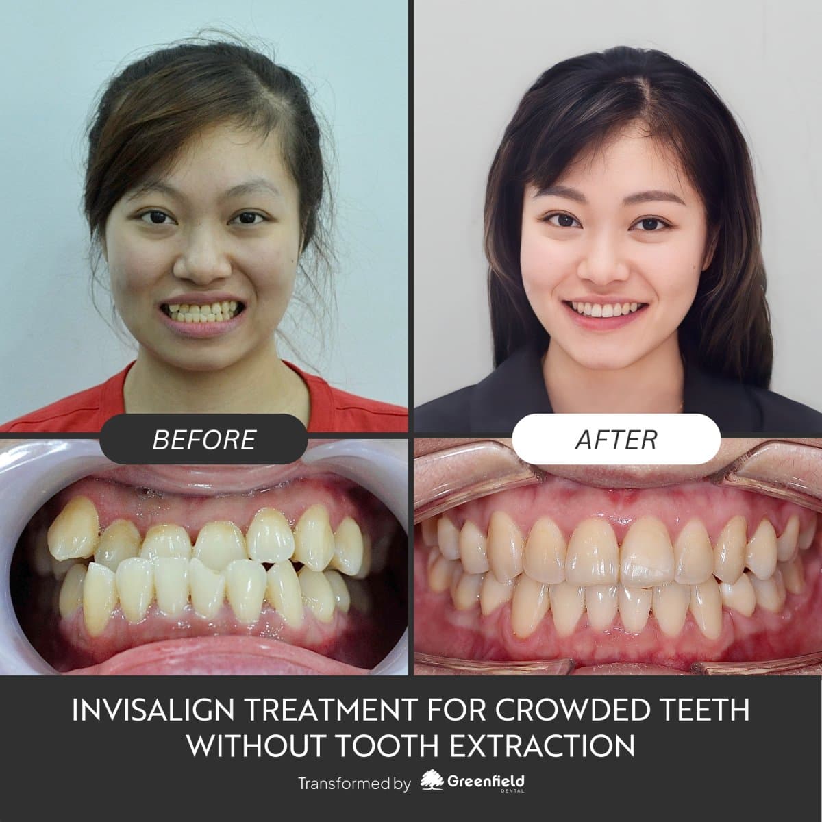 results for crowded teeth