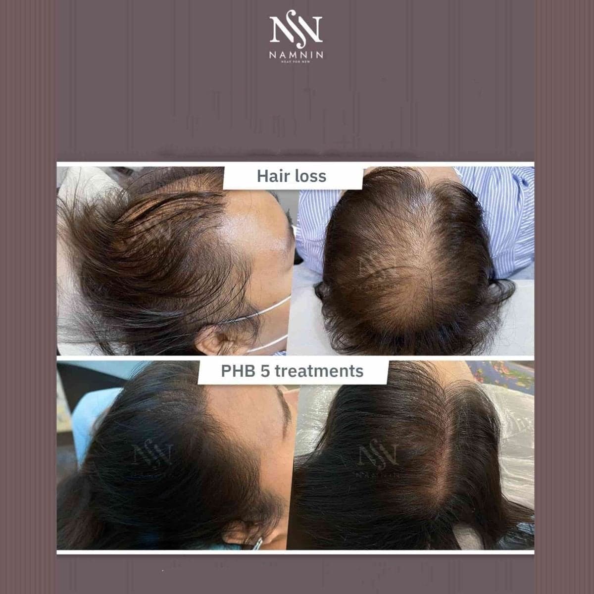 hair mesotherapy